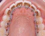 Lingual Braces