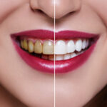 Laser Dentistry