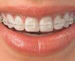 Ceramic Braces