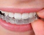 Invisible Braces