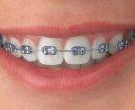 Self Ligating Braces