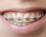 Metal Braces