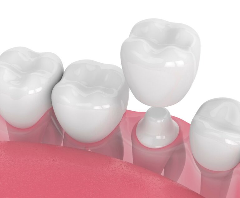 Dental Crowns