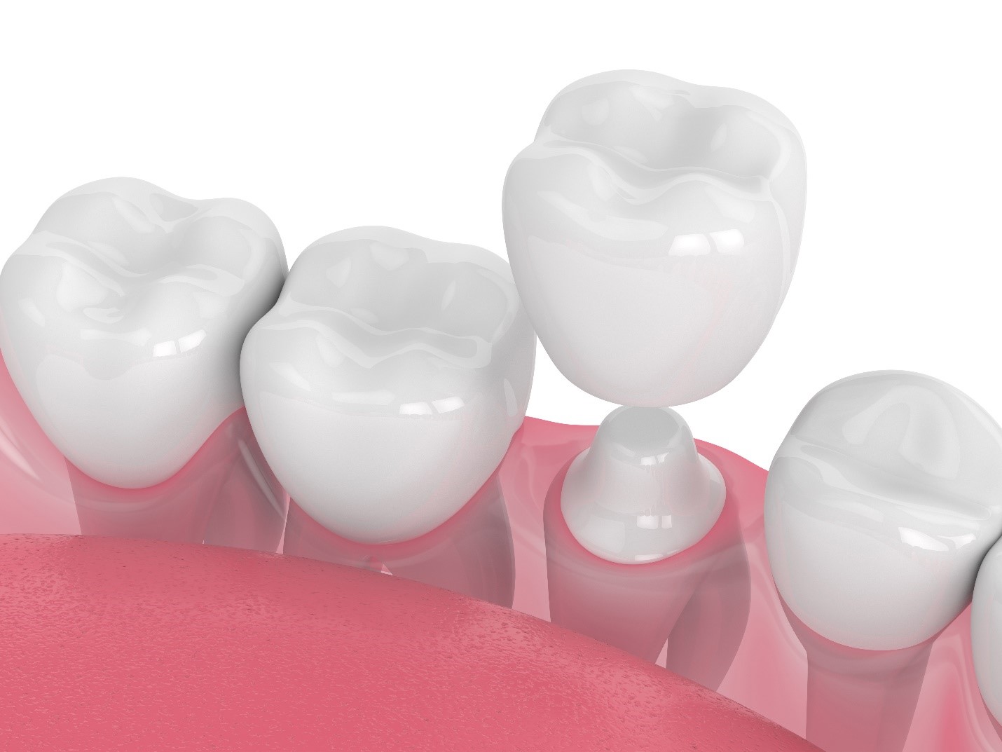 Dental Crowns