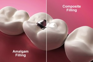White composite filling vs amalgam