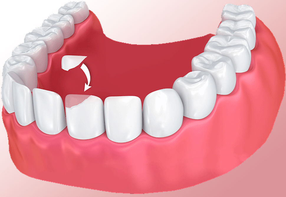 Dental Bonding