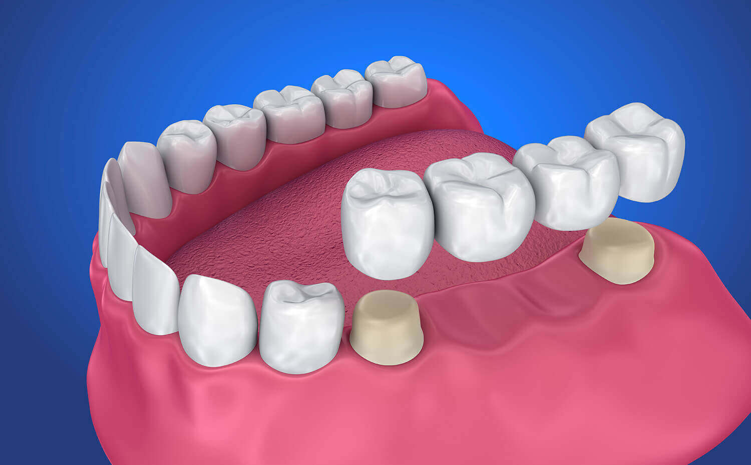 Dental Bridge