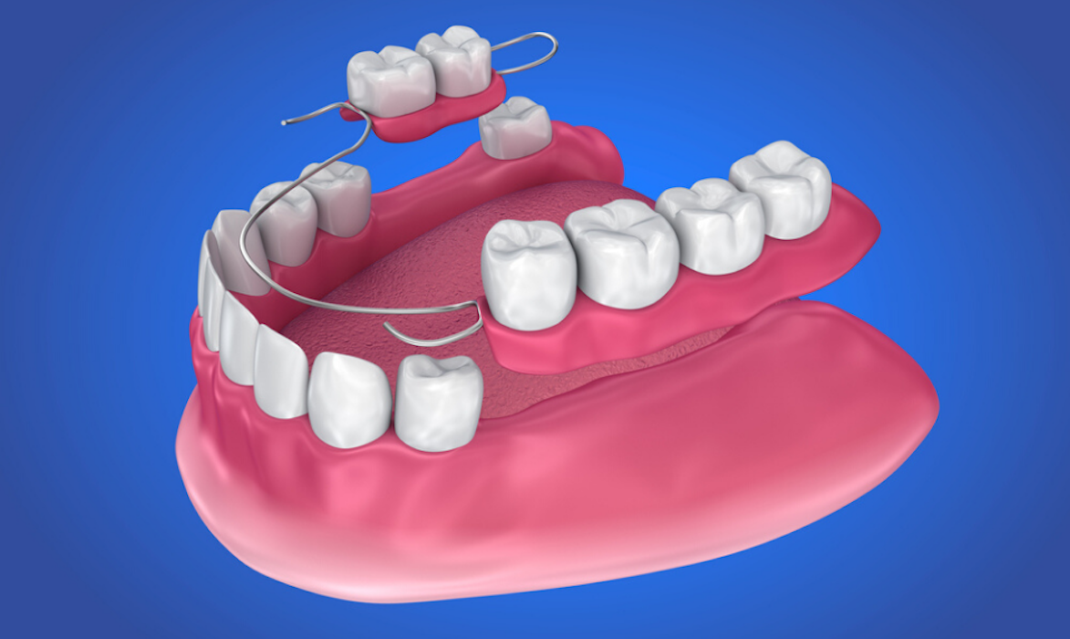 Dentures Mold 3D model