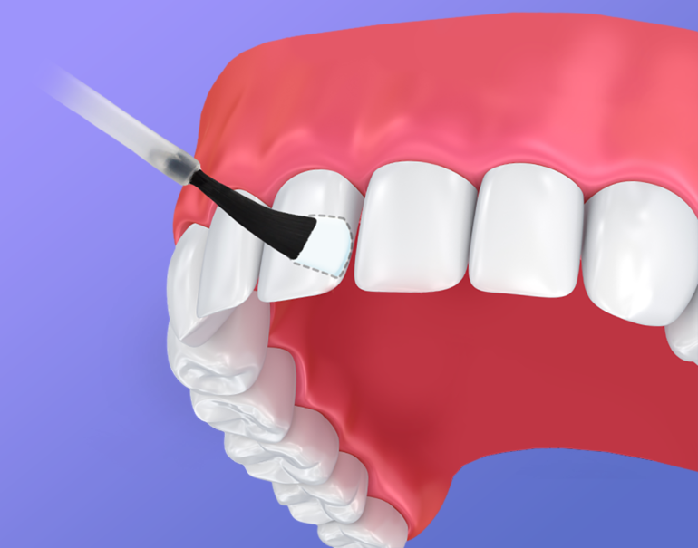 Fluoride Treatment Amelia Perfect Smile