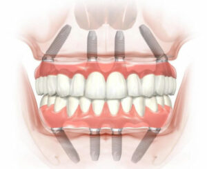 Implant Placement